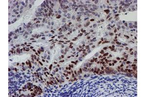 Immunohistochemical staining of paraffin-embedded Adenocarcinoma of Human endometrium tissue using anti-UBE2E3 mouse monoclonal antibody. (UBE2E3 Antikörper)