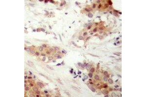 Immunohistochemical analysis of Cyclin D3 (pT283) staining in human breast cancer formalin fixed paraffin embedded tissue section. (Cyclin D3 Antikörper  (C-Term, pSer283))