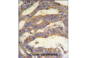 RSAD1 Antibody IHC analysis in formalin fixed and paraffin embedded human colon carcinoma followed by peroxidase conjugation of the secondary antibody and DAB staining. (RSAD1 Antikörper  (C-Term))