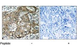 Immunohistochemical analysis of paraffin-embedded human breast carcinoma tissue using FOXO1 polyclonal antibody  .