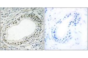 Immunohistochemistry analysis of paraffin-embedded human prostate carcinoma tissue, using RPL36 Antibody. (RPL36 Antikörper  (AA 51-100))