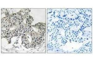 Immunohistochemistry analysis of paraffin-embedded human breast carcinoma tissue using PXMP3 antibody. (PEX2 Antikörper  (N-Term))