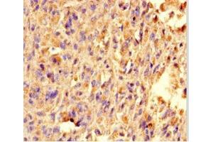 Immunohistochemistry of paraffin-embedded human melanoma using ABIN7172348 at dilution of 1:100 (TRAK1 Antikörper  (AA 101-300))