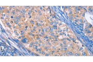 Immunohistochemistry of paraffin-embedded Human cervical cancer using CD61 Polyclonal Antibody at dilution of 1:30 (Integrin beta 3 Antikörper)