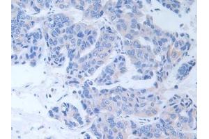 Detection of ALT in Human Breast cancer Tissue using Polyclonal Antibody to Alanine Aminotransferase (ALT) (ALT Antikörper  (AA 255-492))