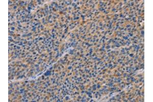 The image on the left is immunohistochemistry of paraffin-embedded Human liver cancer tissue using ABIN7192619(SPAG6 Antibody) at dilution 1/30, on the right is treated with synthetic peptide. (SPAG6 Antikörper)