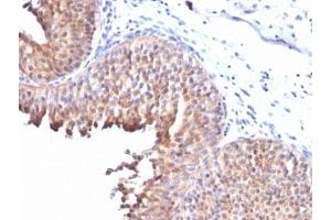 IHC testing of FFPE human bladder carcinoma with Keratin 10 antibody (clone KRT10/844). (Keratin 10 Antikörper)