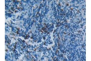 Detection of S100A8 in Human Lung cancer Tissue using Polyclonal Antibody to S100 Calcium Binding Protein A8 (S100A8) (S100A8 Antikörper  (AA 1-93))