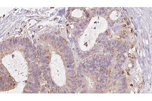 ABIN6272979 at 1/100 staining Human liver cancer tissue by IHC-P. (RAB3D Antikörper  (Internal Region))