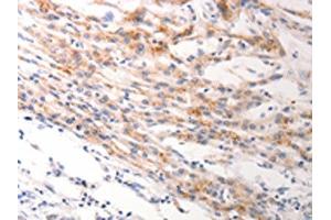 The image on the left is immunohistochemistry of paraffin-embedded Human lung cancer tissue using ABIN7191245(KRT6A/KRT6B/KRT6C Antibody) at dilution 1/40, on the right is treated with synthetic peptide. (KRT6A/KRT6B/KRT6C Antikörper)