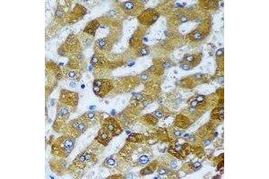 Immunohistochemical analysis of AMCase staining in human liver cancer formalin fixed paraffin embedded tissue section. (CHIA Antikörper)