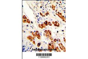 Formalin-fixed and paraffin-embedded human hepatocarcinoma with CEACAM Antibody (N-term), which was peroxidase-conjugated to the secondary antibody, followed by DAB staining. (CEACAM5 Antikörper  (N-Term))