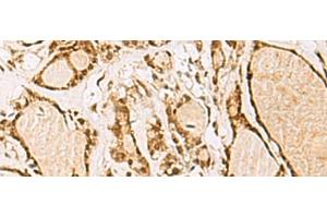 Immunohistochemistry of paraffin-embedded Human thyroid cancer tissue using NIPBL Polyclonal Antibody at dilution of 1:55(x200) (NIPBL Antikörper)
