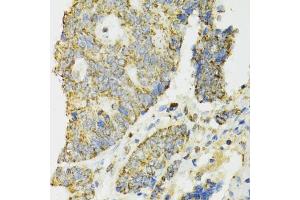 Immunohistochemistry of paraffin-embedded human colon carcinoma using IDH2 antibody. (IDH2 Antikörper)