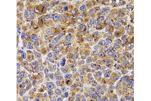 Immunohistochemistry of paraffin-embedded Mouse cancer using UBE2R2 Polyclonal Antibody at dilution of 1:100 (40x lens).