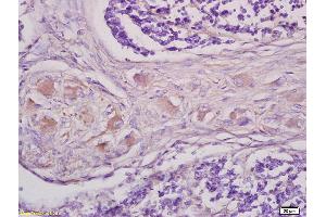 Formalin-fixed and paraffin embedded human lung carcinoma tissue labeled with Anti GRM1 Polyclonal Antibody,Unconjugated (bs1803R) at 1:200 followed by conjugation to the secondary antibody and DAB staining. (mGluR1 + mGluR5 Antikörper  (AA 651-750))