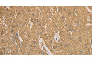 Immunohistochemistry of paraffin-embedded Human liver cancer tissue using CD40 Polyclonal Antibody at dilution 1:70 (CD40 Antikörper)