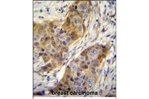 ANR39 Antibody (C-term) (ABIN655104 and ABIN2844736) immunohistochemistry analysis in formalin fixed and paraffin embedded human breast carcinoma followed by peroxidase conjugation of the secondary antibody and DAB staining. (ANKRD39 Antikörper  (C-Term))