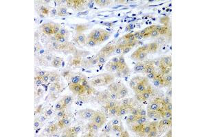Immunohistochemistry of paraffin-embedded human liver cancer using RARRES2 antibody (ABIN5974187) at dilution of 1/200 (40x lens). (Chemerin Antikörper)