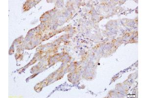 Formalin-fixed and paraffin embedded human gastric carcinoma labeled with Anti-Cyclin M2 Polyclonal Antibody, Unconjugated  at 1:200 followed by conjugation to the secondary antibody and DAB staining (Cyclin M2 Antikörper  (AA 51-150))