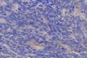 Immunohistochemistry analysis of paraffin-embedded human colon cancer using TGT (ABIN7076024) at dilution of 1: 6400 (tRNA-Guanine Transglycosylase Antikörper)