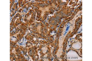 Immunohistochemistry of Human cervical cancer using MBNL3 Polyclonal Antibody at dilution of 1:30 (MBNL3 Antikörper)