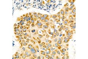 Immunohistochemistry of paraffin embedded human lung cancer using Notch4 (ABIN7074863) at dilution of 1:600 (400x lens)
