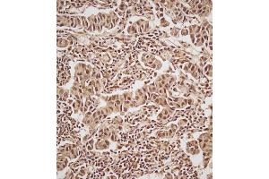 Immunohistochemical analysis of (ABIN657470 and ABIN2846498) on paraffin-embedded Human breast carcinoma tissue. (Estrogen Receptor alpha Antikörper  (AA 246-273))