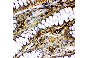 Anti-p73 antibody, (ABIN3043469), IHC(P)IHC(P): Human Intestinal Cancer Tissue (Tumor Protein p73 Antikörper  (AA 1-198))