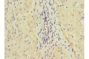 Immunohistochemistry of paraffin-embedded human liver cancer using ABIN7154098 at dilution of 1:100
