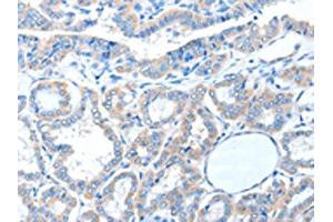 The image on the left is immunohistochemistry of paraffin-embedded Human thyroid cancer tissue using ABIN7128233(ADAM21 Antibody) at dilution 1/15, on the right is treated with fusion protein. (ADAM21 Antikörper)