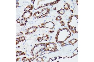 Immunohistochemistry of paraffin-embedded human thyroid cancer using L1 Rabbit pAb (ABIN6134555, ABIN6137248, ABIN6137250 and ABIN6215529) at dilution of 1:100 (40x lens). (ATG16L1 Antikörper  (AA 200-300))