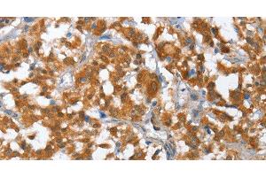 Immunohistochemistry of paraffin-embedded Human thyroid cancer using TP53BP2 Polyclonal Antibody at dilution of 1:35 (TP53BP2 Antikörper)
