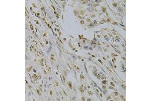 Immunohistochemistry of paraffin-embedded human gastric cancer using SUMO1 Antibody (ABIN5971157) at dilution of 1/200 (40x lens). (SUMO1 Antikörper)