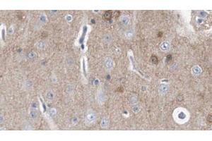 ABIN6278481 at 1/100 staining Human brain cancer tissue by IHC-P. (IL20RA Antikörper  (C-Term))