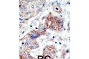 Formalin-fixed and paraffin-embedded human cancer tissue reacted with the primary antibody, which was peroxidase-conjugated to the secondary antibody, followed by DAB staining. (EPH Receptor B3 Antikörper  (N-Term))
