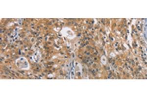 Immunohistochemistry of paraffin-embedded Human gastric cancer tissue using ZADH2 Polyclonal Antibody at dilution of 1:100(x200) (ZADH2 Antikörper)
