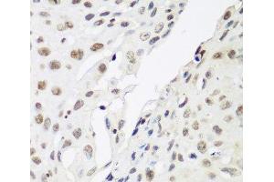 Immunohistochemistry of paraffin-embedded Human lung cancer using CBX3 Polyclonal Antibody at dilution of 1:200 (40x lens). (CBX3 Antikörper)