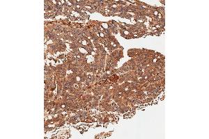 Immunohistochemical analysis of paraffin-embedded Human colon carcinoma tissue using (ABIN656331 and ABIN2845630) performed on the Leica® BOND RXm.