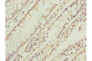 Immunohistochemistry of paraffin-embedded human colon cancer using ABIN7173269 at dilution of 1:100 (TMEM71 Antikörper  (AA 1-210))