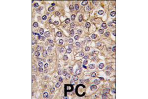 Formalin-fixed and paraffin-embedded human prostate carcinoma tissue reacted with IL1R1 polyclonal antibody  , which was peroxidase-conjugated to the secondary antibody, followed by DAB staining . (IL1RL2 Antikörper  (C-Term))