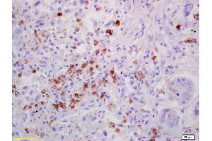 Formalin-fixed and paraffin embedded human lung carcinoma labeled with Anti-IL-7 Polyclonal Antibody, Unconjugated (ABIN734783) at 1:200 followed by conjugation to the secondary antibody and DAB staining (IL-7 Antikörper  (AA 51-154))
