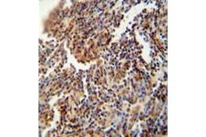 Immunohistochemistry analysis in formalin fixed and paraffin embedded human lung carcinoma reacted with HFM1 Antibody (C-term) followed which was peroxidase conjugated to the secondary antibody and followed by DAB staining. (HFM1 Antikörper  (C-Term))