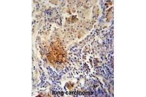 TYROBP Antibody (C-term) immunohistochemistry analysis in formalin fixed and paraffin embedded human lung carcinoma followed by peroxidase conjugation of the secondary antibody and DAB staining. (TYROBP Antikörper  (C-Term))