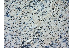 Immunohistochemical staining of paraffin-embedded Adenocarcinoma of ovary tissue using anti-TMEM100mouse monoclonal antibody. (TMEM100 Antikörper)