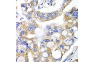 Immunohistochemistry of paraffin-embedded human liver cancer using PNLIP antibody (ABIN5975718) at dilution of 1/100 (40x lens).