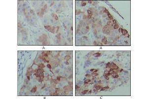 Immunohistochemical analysis of paraffin-embedded human hepatocarcinoma (A), breast carcinoma (B) and lung cancer tissues (C), showing cytoplasmic localization with DAB staining using PEG10 antibody. (PEG10 Antikörper)