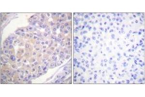 Immunohistochemistry analysis of paraffin-embedded human breast carcinoma, using p130 Cas (Phospho-Tyr165) Antibody. (BCAR1 Antikörper  (pTyr165))