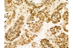 ABIN7094276 and ABIN7098323 at 1/100 staining Human lung cancer by IHC-P. (Histone Cluster 1, H1t (HIST1H1T) (Internal Region) Antikörper)