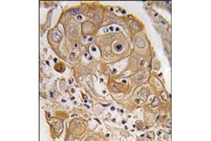 Formalin-fixed and paraffin-embedded human lung carcinoma tissue reacted with PTRF antibody (N-term), which was peroxidase-conjugated to the secondary antibody, followed by DAB staining. (PTRF Antikörper  (N-Term))